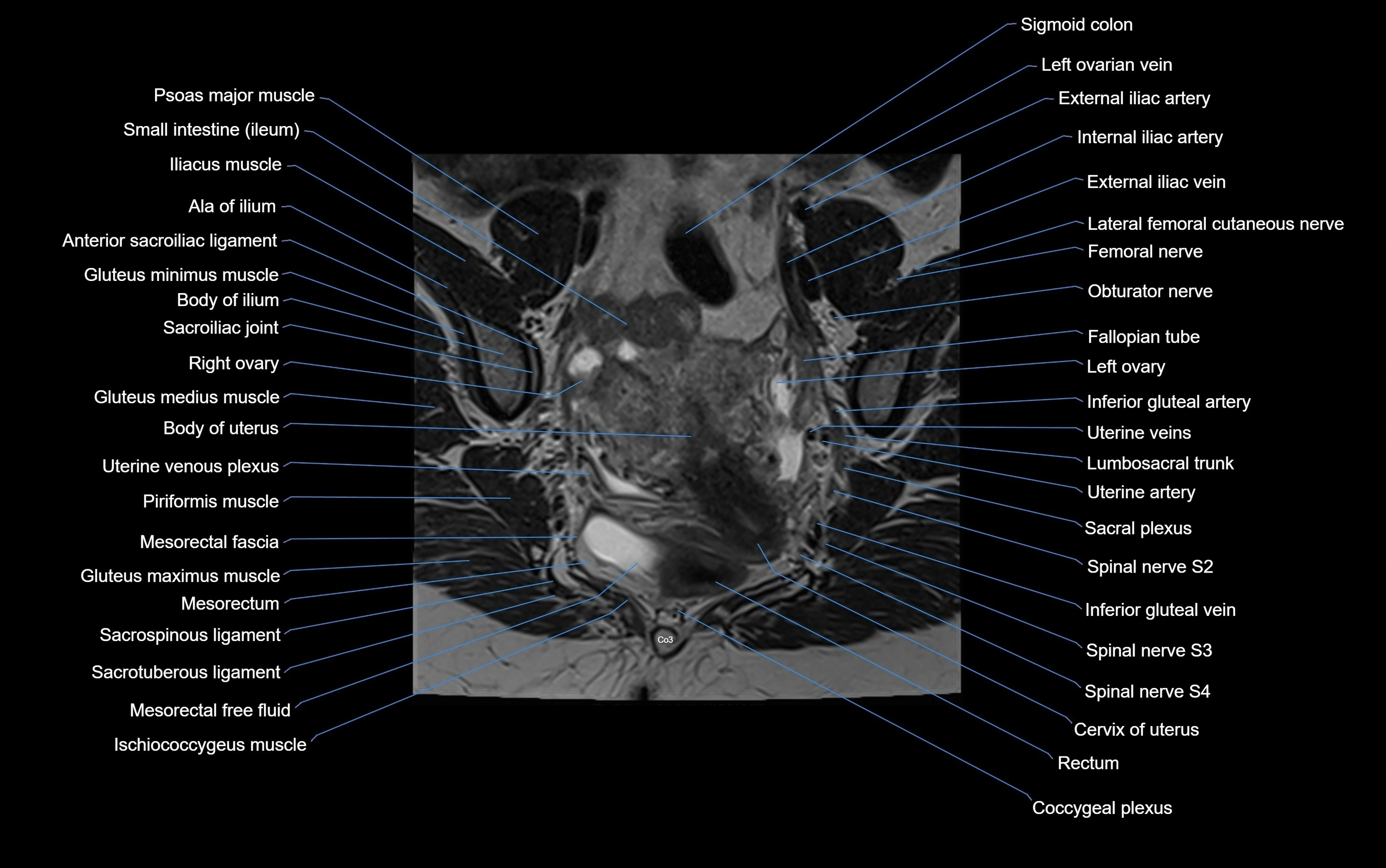 MRI sacroiliac joint coronal cross sectional anatomy  radiology  image-img-00001-00004.webp